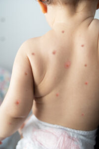 if you have Chickenpox new baby disease contact Nirnayan health Care